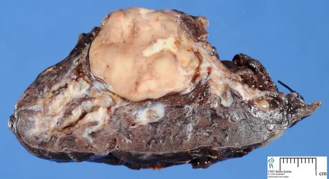 Gross pathology image of a lung carcinoid tumor. The specimen shows a well-circumscribed, round to oval mass filling the bronchial lumen, consistent with endobronchial growth. Central tumors arise near mainstem or lobar bronchi; peripheral lesions may be asymptomatic. The cut surface is yellow-gray with occasional fibrous septa; the overlying bronchial mucosa may be intact, though infiltration of bronchial wall and adjacent parenchyma is possible. The lesion may be sessile or pedunculated; endobronchial component occurs in a subset of typical carcinoids and a minority of atypical variants. Peripheral tumors are more likely to show spindle cell patterns; centrally located lesions may lead to obstructive pneumonia, abscesses, or bronchiectasis. Paraneoplastic manifestations (Cushing, acromegaly, carcinoid syndrome) are rare. Histology would show neuroendocrine tumor nests with uniform cells; salt-and-pepper chromatin is typical; spindle morphology may be present in atypical carcinoids. Final diagnosis requires histopathology and immunohistochemistry. This image serves educational, diagnostic, and reference purposes for surgical pathology, oncology, and radiology correlation. Recognizing such gross patterns aids intraoperative sampling and aids clinical-pathologic correlation. Typical carcinoids are generally indolent neuroendocrine tumors; atypical variants have higher mitotic rate and necrosis, impacting prognosis and management. Clinical imaging correlates with gross findings on CT. Useful for pathology reporting and teaching.