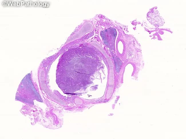 Histopathology image of a central pulmonary carcinoid tumor obtained from bronchial tissue. Imaging modality: light microscopy of formalin-fixed, paraffin-embedded lung biopsy with Hematoxylin and Eosin (H&E) stain. The specimen shows a luminal, endobronchial mass arising within the mainstem/lobar bronchus with preservation of surrounding lung architecture. On low-power view, tumor cells are arranged in uniform nests and sheets embedded in a delicate vascular stroma, with organoid and palisading growth patterns characteristic of neuroendocrine neoplasms. Cells are round to oval with relatively uniform nuclei and finely stippled (salt-and-pepper) chromatin; cytoplasm is scant to moderate. Mitotic figures are rare; necrosis is not prominent, supporting a diagnosis of a well-differentiated (typical) carcinoid. The lesion markedly occludes the bronchial lumen, consistent with endobronchial involvement and potential postobstructive changes such as pneumonia, abscess formation, or bronchiectasis in clinical context. Clinically, central bronchial carcinoids comprise about two-thirds of cases and commonly present with hemoptysis and airway obstruction; peripheral carcinoids are less frequent and often incidental. This histology is crucial for differential diagnosis against other neuroendocrine and non-neuroendocrine lung carcinomas; confirmatory immunohistochemistry (chromogranin A, synaptophysin, CD56) is often supportive. This image thus exemplifies central bronchial carcinoid pathology and supports diagnostic biopsy planning. Correlation with radiology and endobronchial imaging enhances clinical management decisions.