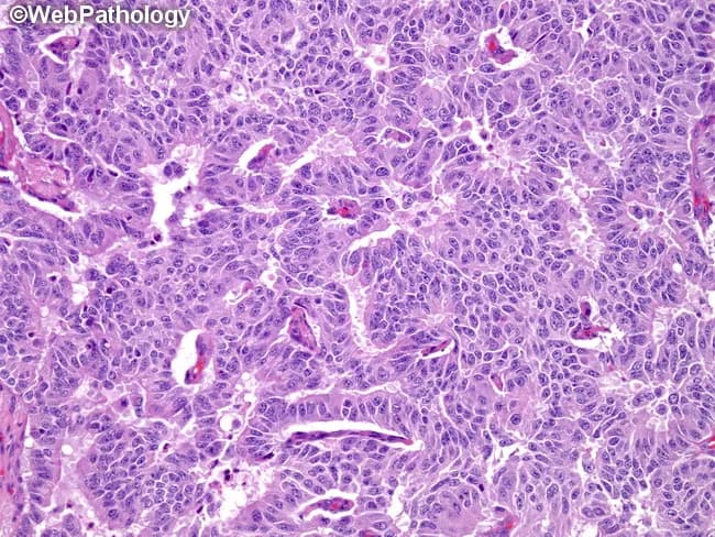 Imaging modality: light microscopy of an H&E stained histology slide of a carcinoid/neuroendocrine tumor. Primary subject: carcinoid tumor with trabecular architecture; other growth patterns such as nesting, rosettes, papillary or solid patterns are described in the literature, but the presented field most prominently demonstrates a classic trabecular arrangement of uniform, round to oval cells with salt-and-pepper chromatin and relatively scant cytoplasm. The tumor cells are arranged in interlacing cords and columns separated by delicate vascularized stroma, contributing to a highly vascular background. Mitotic activity is typically low in well-differentiated carcinoids, with mild cytologic atypia; necrosis is uncommon but may be present in larger tumors. Cytoplasm is amphophilic to eosinophilic; nuclei are round to elongated, with stippled chromatin. Rosettes or microcystic formations may be seen occasionally. The background stroma may show hyalinization, calcification, mucin, amyloid, bone or cartilage formation. Immunophenotype is typically positive for neuroendocrine markers such as synaptophysin and chromogranin A, supporting a neuroendocrine tumor diagnosis. Clinically, these lesions arise in the GI tract or bronchopulmonary system and may express diverse patterns; accurate histologic classification informs prognosis, surveillance, and therapeutic strategy, including surgical resection and consideration of adjuvant therapy in higher-grade cases. This aids in differential diagnosis and therapy planning.