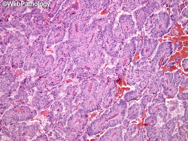 Imaging modality and technique: light microscopy of an H&E stained histology section. The specimen represents a carcinoid tumor, a well differentiated neuroendocrine neoplasm, captured in cross sections that reveal multiple growth patterns. The tumor nests, trabecular bands, rosette arrangements, and papillary or pseudoglandular formations predominate, with occasional solid areas and peripheral spindle cell arrangements typical of peripheral neuroendocrine tumors. The cells are uniform with round to oval nuclei, stippled 'salt and pepper' chromatin, and modest eosinophilic cytoplasm; mitotic activity is variable but generally low in well differentiated lesions. The background stroma is highly vascular and may show hyalinization, calcification, and in some cases mucin, amyloid, bone, or cartilage formation, reflecting the diverse morphologic spectrum of carcinoids. Immunophenotype is typically neuroendocrine, with positivity for chromogranin A and synaptophysin in well differentiated lesions; Ki-67 proliferation index correlates with grade. Clinically, recognition of the architectural heterogeneity is important, as carcinoid tumors may mimic other neoplasms on limited samples. The described pattern diversity informs differential diagnosis, guides immunohistochemical workup, and supports diagnosis of a neuroendocrine tumor. This image is educational for pathology learners, highlighting classic patterns of growth and the characteristic stromal background that aid in distinguishing carcinoid/neuroendocrine tumors from adenocarcinomas and poorly differentiated neoplasms.