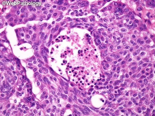 A histologic section of lung tissue stained with Hematoxylin and Eosin, examined under light microscopy at high magnification (approximately 400x). The tumor displays neuroendocrine morphology with organoid nesting and trabecular growth patterns. Tumor cells are uniform, polygonal with moderate cytoplasm and round nuclei with finely dispersed, salt-and-pepper chromatin. Notable mitotic activity is present, ranging from 2 to 10 mitoses per 10 high-power fields, and punctate necrosis is evident within some tumor nodules. The architectural arrangement suggests a well-differentiated neuroendocrine neoplasm consistent with an atypical carcinoid, as opposed to a typical carcinoid which lacks necrosis and shows lower mitotic rates. Immunohistochemical studies (not shown) would typically show neuroendocrine marker positivity (chromogranin A, synaptophysin, CD56) supporting a neuroendocrine neoplasm. The combination of mitotic activity and necrosis distinguishes atypical carcinoid from typical carcinoid, which lacks significant necrosis and has lower mitotic rates. This histology correlates with a higher risk of nodal and distant metastasis and a more aggressive clinical course, with a 5-year survival around 60% in reported series. Smoking history is more commonly associated compared with typical carcinoids but not universal. TP53 and RB1 mutations are seen in a subset (~20%) of atypical carcinoids. This image is representative for educational purposes in pathology, pulmonology, oncology, and medical training to illustrate diagnostic criteria and prognostic implications.