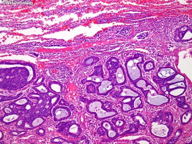 Imaging modality: Light microscopy of hematoxylin and eosin stained histology section from breast tissue. Section shows lobular and ductal glandular elements scattered among fibrous stroma and adipose tissue. At low magnification abundant heterogenous glandular structures display round to elongated lumens, lined by cuboidal to low columnar epithelium. The ducts vary in size with some dilated, cyst-like spaces; the surrounding stroma is fibrous with connective tissue strands and occasional inflammatory infiltrates not obvious. Adipose tissue occupies adjacent parenchyma, giving a mixed composition typical of breast. Cellular morphology reveals typical epithelial lining with basally oriented nuclei, inconspicuous nucleoli at this field; no convincing mitotic activity. No obvious invasion into surrounding stroma; myoepithelial layer presence cannot be assessed at this magnification. The image highlights normal breast architecture with glandular ducts, lobules, and supportive stroma and adipose tissue; features could reflect benign fibrocystic changes or ductal proliferations rather than malignancy in absence of nuclear atypia or stromal invasion. Clinically relevant for educational purposes: illustrating histologic breast tissue, fibrosis, ductal structures, and potential differential diagnoses including fibrocystic disease, fibroadenoma, DCIS, IDC. Useful for training pathology residents and for comparison with radiologic imaging findings and clinical breast exam in suspicion of benign vs malignant lesions.