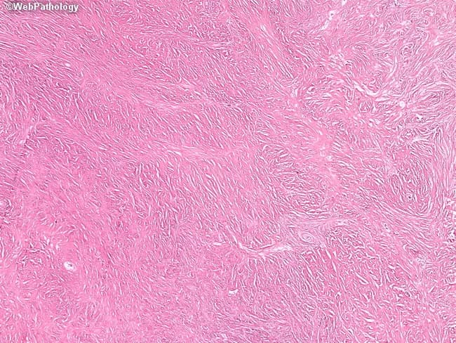 This is a histopathology slide prepared from a soft tissue/dermal biopsy, stained with Hematoxylin and Eosin and evaluated by light microscopy. The tissue shows dense eosinophilic collagen arranged in broad, intersecting fibrous bands with low cellularity. Spindle-shaped fibroblast-like cells are present along the collagenous stroma, exhibiting elongated nuclei and minimal cytologic atypia. Mitotic figures are rare or not evident in the field, and there is no overt necrosis or inflammatory infiltrate. The overall pattern may display a storiform or interlacing fascicular architecture, consistent with fibrous tissue proliferation. The epidermis overlying or surrounding the lesion is not clearly involved in this field, suggesting a dermal/soft tissue process rather than an overt epidermal neoplasm. The histologic impression favors a benign fibrous lesion such as scar tissue- or fibroma-type stroma; however, because desmoid-type fibromatosis and other fibrous tumors can mimic scar on routine sections, correlation with immunohistochemical stains (e.g., beta-catenin for desmoid; CD34 for DFSP) and clinical history is recommended. The diagnostic significance lies in distinguishing non-neoplastic scar from low-grade fibrous neoplasms, guiding management toward observation or surgical excision with clean margins. This image is educational for pathology trainees studying soft tissue histology and differential diagnosis of fibrous lesions.