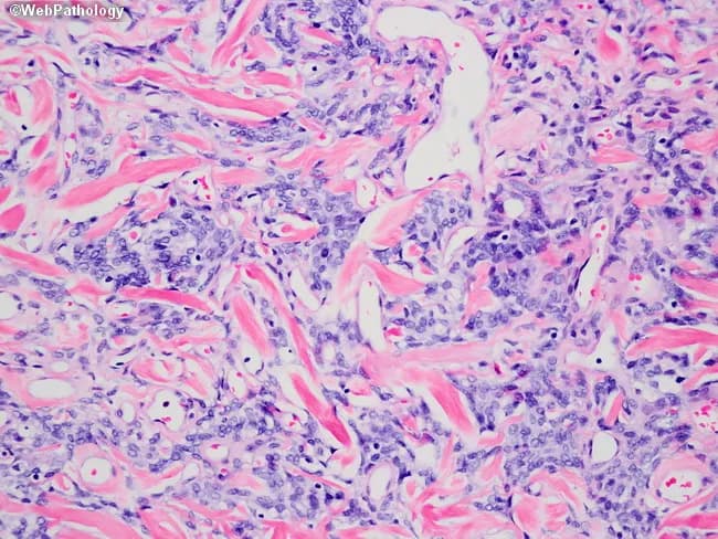 This histopathology image shows a hematoxylin and eosin (H&E) stained soft tissue section examined with bright-field microscopy. The tissue displays a dense, eosinophilic collagen-rich stroma with wavy, interlacing fibers forming an abundant fibrous matrix. Within this matrix are scattered spindle-shaped fibroblasts containing elongated basophilic nuclei. The cellularity is moderate and the vascular channels are present but not prominent. A mild inflammatory infiltrate composed of small lymphocytes and plasma cells is interspersed among the fibrous strands. No evident epithelial elements or malignant cytology are observed in this field, and there is no overt necrosis or high mitotic activity. The overall pattern suggests fibrous tissue proliferation, scar-like remodeling, or a desmoplastic reaction within soft tissue. The image highlights classic histologic features of connective tissue: collagen deposition, fibroblast morphology, and stromal architecture, along with minor inflammatory components. Clinically, these findings are nonspecific without clinical history and ancillary studies but are relevant to differential diagnoses including fibrosis, chronic inflammation, granulation tissue, or low-grade fibrous neoplasms. This slide is useful for teaching about connective tissue histology, pattern recognition for fibrous lesions, and correlating morphological observations with patient presentation and imaging findings to guide diagnosis and management.