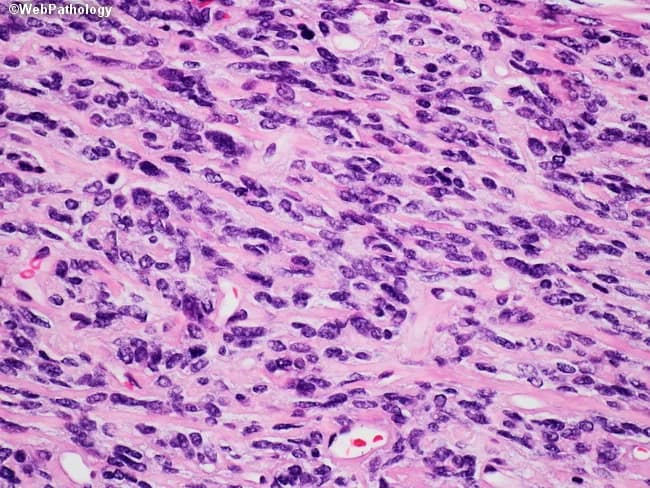 This image is a hematoxylin and eosin stained histology slide viewed under bright-field microscopy at high power, showing a densely cellular soft-tissue lesion comprised of interlacing fascicles of spindle-shaped cells with elongated, hyperchromatic nuclei and scant cytoplasm. The stroma appears collagen-rich and pink, with irregular, elongated mitotic figures scattered throughout; occasional inflammatory cells are present. There is mild-to-moderate cellular pleomorphism and a few multinucleated cells. The overall pattern is inconspicuous for glandular differentiation or epithelial components. No necrosis is conspicuous at this low-magnification region, though focal areas of increased mitotic activity suggest a neoplastic process rather than reactive scar. The cellular arrangement and stromal density resemble fibrosarcoma or other spindle cell sarcomas; however, without immunohistochemical studies, specific lineage cannot be confirmed. Differential diagnoses include malignant peripheral nerve sheath tumor, leiomyosarcoma, and synovial sarcoma, among others, particularly in deep soft tissues. This slide is typically obtained from formalin-fixed, paraffin-embedded tissue and prepared as a routine H&E section for initial histopathologic assessment. Clinically, this morphology may present as a painless soft-tissue mass with infiltrative growth. Diagnostic significance lies in identifying spindle cell neoplasia, guiding immunostaining panels, and correlating with radiologic features to determine extent, margins, and staging. This image is valuable for education, differential diagnosis practice, and pathology training.