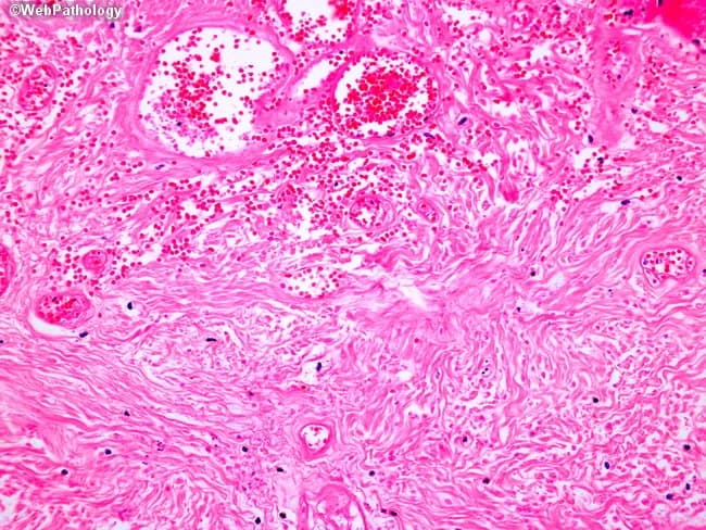Light microscopy of an H&E-stained formalin-fixed tissue section at low to intermediate magnification reveals granulomatous inflammation characterized by well-formed nodular aggregates of epithelioid histiocytes and occasional Langhans-type multinucleated giant cells embedded in a fibrous stromal matrix. The granulomas appear in close association with accentuated lymphocytic cuffs and scattered plasma cells. Central areas show coagulative or caseating necrosis in some nodules, giving a pale eosinophilic center surrounded by a rim of epithelioid cells. The surrounding dermis/soft tissue shows delicate reticular fibers and vascular congestion with perivascular mononuclear infiltrates. There are no overt bacterial organisms evident with standard H&E, though organisms such as mycobacteria or fungi may require special stains (Ziehl-Neelsen, GMS) to confirm infection. The architecture suggests a granulomatous process rather than acute suppurative inflammation. Diagnostic significance: indicative of granulomatous disease; differential includes infectious etiologies (tuberculosis, fungal infections) and noninfectious conditions (sarcoidosis, foreign-body reaction). Clinical correlation recommended with exposure history, immunologic status, and targeted staining/cultures. Potential use cases: educational demonstration of granuloma morphology, pathology student review, differential diagnosis in infectious and granulomatous diseases, histology atlas reference. This description supports search for terms granuloma, epithelioid histiocytes, Langhans giant cells, caseation, TB, sarcoidosis, histopathology.