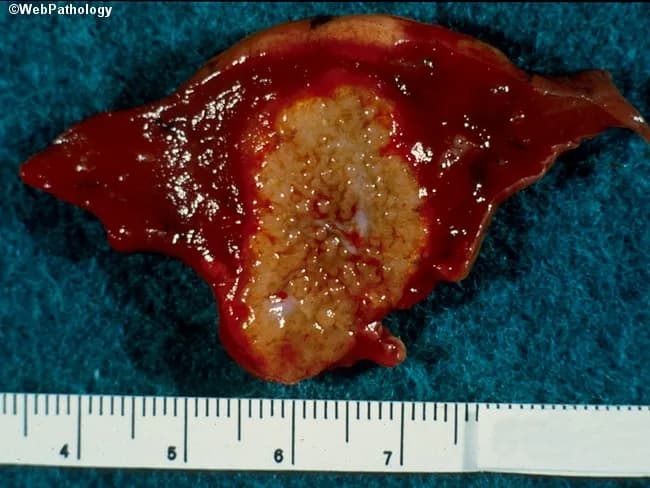 Gross pathology photograph of ex vivo hepatic tissue showing a single, lobulated lesion with a central pale-yellow to tan, crumbly necrotic core surrounded by a hyperemic, reddish-brown peripheral rind. The specimen measures approximately 5.5–6.5 cm in greatest dimension as judged by the metric ruler placed adjacent to the cut surface. The lesion appears well-demarcated from surrounding viable parenchyma, suggesting a focal process such as an infectious granuloma or abscess. The central area exhibits caseous-like necrosis with a cracked, cheese-like consistency; periphery shows congested, friable tissue with mild surface sheen. The overall sample has a smooth to slightly irregular contour. No obvious hemorrhagic stellate patterns noted beyond the margin, though diffuse vascularity is evident on the surface. The cut surface reveals a clear contrast between necrotic core and inflamed rim; there may be microcavitation within the core. These macroscopic features are compatible with granulomatous hepatic disease, notably tuberculosis or fungal infection, though bacterial abscess or parasitic granuloma cannot be excluded without microbiologic and histologic confirmation. This image is useful for education on gross-pathology correlation, differential diagnosis of hepatic necrotizing granulomas, and teaching rounds on infectious liver lesions. Correlate with histology, Ziehl-Neelsen and special stains, culture, and clinical context.