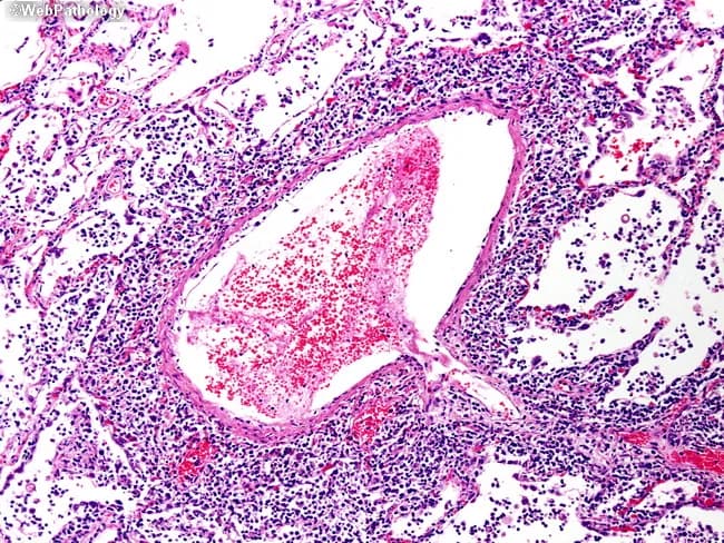 This is a light microscopy image of a tissue biopsy prepared for histopathology and stained with Hematoxylin and Eosin (H&E). The section displays a prominent blood vessel at the center with a lumen containing erythrocytes and a thickened, eosinophilic wall. Surrounding the vessel is dense perivascular inflammatory infiltrate composed of small, dark-staining nuclei (lymphocytes and macrophages) with occasional plasma cells. The adjacent stroma shows interstitial edema and mild congestion. The vascular intima may be focally thickened, and there is mild adventitial inflammation. The background parenchyma appears fragmented with dispersed inflammatory cells, making any definitive parenchymal pattern (e.g., granulomas, necrosis) not distinctly visible. No obvious malignant cells are evident in this field. The image highlights features consistent with an inflammatory or vasculitic process, such as endarteritis or perivasculitis, though infection cannot be excluded without ancillary studies. Diagnostic significance: In a patient with systemic inflammatory symptoms, this pattern supports a vasculitic or immune-mediated vascular injury diagnosis and prompts serologic testing (ANCA), infectious workup, and clinical correlation. Potential clinical use cases include evaluation of suspected vasculitis, inflammatory lung or soft-tissue lesions, and research into vascular inflammatory pathology. This description emphasizes terminology suitable for indexing, including vasculitis, perivasculitis, endarteritis, and H&E histology cues.