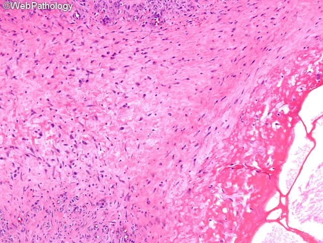 High magnification light microscopy of a formalin-fixed tissue section stained with hematoxylin and eosin (H&E) reveals a focal area of fibrinoid necrosis within the vessel wall (lower right) accompanied by cystic change. Surrounding this necrotic core is a prominent zone of vascular tissue characterized by marked fibroblastic proliferation and remodeling, with spindle-shaped cells and thickened intima forming a dense, fibrous stroma (upper left). The necrotic area displays eosinophilic, amorphous material consistent with fibrin deposition, often seen in necrotizing vasculitis. The adjacent parenchyma shows a relatively preserved architecture with scattered inflammatory cells, a pattern that may reflect an early or localized vasculitic process rather than a fully developed granulomatous lesion. Overall, the image demonstrates a cascade from acute fibrinoid injury toward progressive fibrous scarring, typical of angiitis with fibroproliferative response. The combination of fibrinoid necrosis and fibroblastic proliferation within a vascular niche has diagnostic relevance for necrotizing vasculitis syndromes (e.g., polyarteritis nodosa, granulomatosis with polyangiitis) and related connective tissue diseases. Clinically, these features are relevant for differential diagnosis, prognosis, and therapeutic decisions, as they inform decisions about immunosuppressive therapy, vascular risk assessment, and correlation with serology such as ANCA. This micrographic pattern is essential for pathology education and case documentation.
