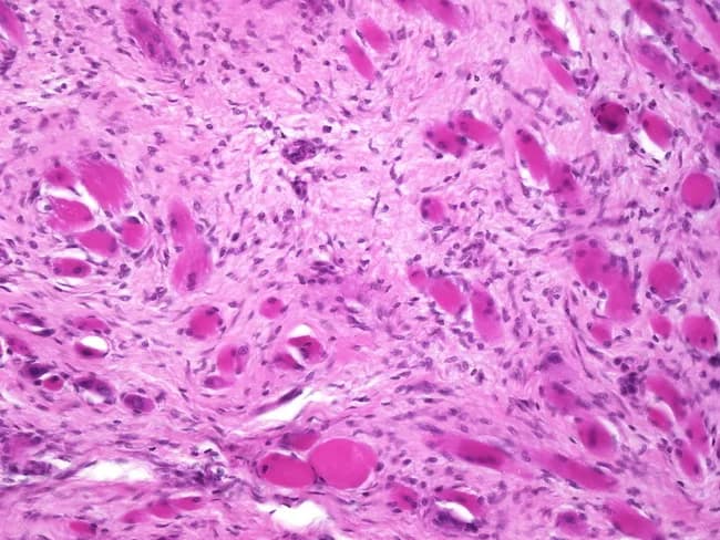 Histopathology image acquired from neonatal neck muscle (sternocleidomastoid) illustrating congenital fibromatosis of infancy (fibromatosis coli) within the lower third of the SCM. Modality: light microscopy on hematoxylin and eosin stained sections. The section shows dense, hypocellular fibrous connective tissue interposed between residual atrophic skeletal muscle fibers. The muscle fibers appear angular, fragmented, and sparsely populated by cross sectional myofibers with lost striations, while spindle-shaped fibroblasts populate the stroma. Occasional multinucleated giant cells are absent; there is minimal inflammatory infiltrate. The overall pattern is scar-like fibrosis replacing contractile parenchyma, with relative preservation of surrounding adipose tissue. The histology is characteristic of fibromatosis coli (congenital muscular torticollis), typically linked to birth trauma and obstetric deliveries (forceps, breech). Clinically, this lesion is benign and non-neoplastic, often resolving with physiotherapy or observation in mild cases; prognosis is favorable with appropriate management. Differential considerations include infantile rhabdomyosarcoma, inflammatory myopathies, and other congenital neck masses; histology helps differentiate based on absence of malignant features and presence of dense fibrous stroma with atrophic muscle. The diagnostic significance lies in correlating perinatal injury history with persistent neck tilt in newborns and guiding conservative therapy. This correlation aids targeted physiotherapy and monitoring.