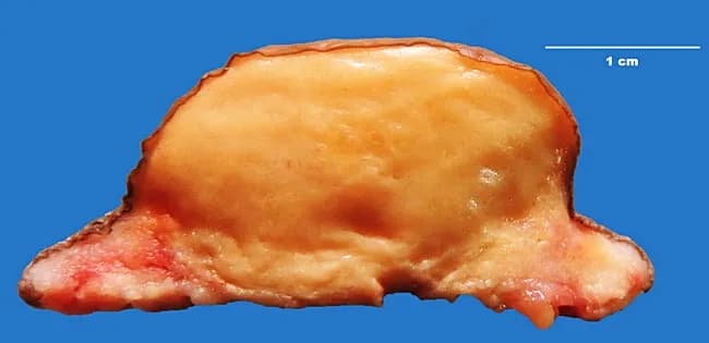 This is a gross pathology photograph of an excised tuberous xanthoma from an 18-year-old female with familial hypercholesterolemia (type IIa). The specimen shows a solitary, well-circumscribed, nodular lesion removed from periarticular soft tissue around a knee (and noted at elbows and toes in the clinical history). On gross inspection, the cut surface is homogeneously pale to yellow-orange, soft, and slightly lobulated, with a glossy, lipid-rich appearance consistent with lipid-laden macrophage infiltration. Histology is diagnostic of xanthoma, characterized by dense aggregates of foamy macrophages (lipid-laden histiocytes) in the dermis/subcutaneous tissue with accompanying chronic inflammatory infiltrate and varying degrees of fibrosis in long-standing lesions. The lipid-rich cytoplasm creates the characteristic yellow hue. Systemic findings include elevated total cholesterol and LDL cholesterol with normal triglycerides, VLDL, and HDL; thyroid function is normal. This phenotype corresponds to familial hypercholesterolemia, type IIa, typically due to LDL receptor or ApoB gene defects. Xanthomas are not neoplasms but reactive lipid deposits that reflect prolonged hyperlipidemia and local tissue remodeling. Clinically relevant implications include increased risk of premature atherosclerotic cardiovascular disease, guiding lipid-lowering therapy and family screening. Correlation with histologic confirmation supports diagnosis and informs genetic counseling, lifestyle modification, and pharmacotherapy, such as statins, PCSK9 inhibitors, or ezetimibe.