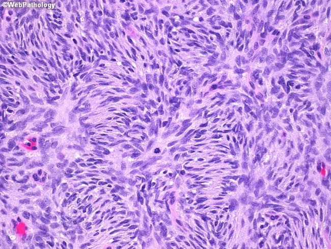 Imaging modality and technique: Light microscopy of a formalin-fixed skin biopsy stained with Hematoxylin and Eosin, imaged at high power (HPF) to highlight cellular detail. Anatomical location: dermis with superficial to mid-dermal spindle cell proliferation infiltrating the subcutaneous fat in a common dermatofibrosarcoma protuberans (DFSP) pattern. Morphology: uniform slender spindle cells arranged in storiform (cartwheel) pattern with interlacing rows and a lightly basophilic, fibrillary stroma; nuclei elongated, with mild to moderate hyperchromasia and inconspicuous mitotic figures. Inset image notes a mitotic figure near the center, illustrating active proliferation in some fields. Immunohistochemical context: classic DFSP demonstrates strong CD34 positivity in tumor cells (CD34+), aiding distinction from benign fibrous histiocytoma, which is typically CD34 negative or variably positive. Lack of significant pleomorphism and absence of prominent necrosis argue against higher-grade sarcoma. Diagnostic significance: this morphological constellation supports DFSP, a locally aggressive dermal/subcutaneous spindle cell neoplasm with infiltrative margins that requires wide excision with clear margins to reduce recurrence risk. Clinical correlation: in suspected DFSP, correlate with CD34 immunostaining, patient age, and tumor location, and consider differential diagnoses including dermatofibroma, malignant fibrous histiocytoma, and cutaneous spindle cell sarcomas. Educational use: representative high-power features useful for histology training and differential diagnosis in dermatopathology.