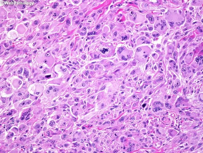 High-magnification hematoxylin and eosin stained skin biopsy reveals a highly atypical spindle cell neoplasm with storiform and fascicular growth patterns. Tumor cells are pleomorphic, with elongated nuclei, hyperchromasia, conspicuous nucleoli, and abundant mitotic figures including atypical mitoses, consistent with a high-grade sarcomatoid phenotype. The lesion displays prominent cellularity in a dermal-to-subcutaneous setting, with occasional multinucleated cells and hemorrhagic/inflammatory background. Immunophenotype can mimic melanoma or spindle cell squamous cell carcinoma, necessitating ancillary testing. Atypical fibroxanthoma (AFX) typically shows positivity for vimentin, HAM56, and alpha1-antitrypsin, while lacking lineage-specific markers. In this case, tumor cells are negative for S-100, Melan A (MART-1), desmin, and cytokeratins, supporting non-epithelial and non-melanocytic differentiation. The differential diagnosis includes spindle cell melanoma, spindle cell squamous cell carcinoma, and other cutaneous sarcomas; IHC panel is critical to exclude melanocytic and epithelial origins. Clinically, AFX arises in sun-exposed, chronically damaged skin of elderly patients and is treated by complete surgical excision with clear margins; prognostication depends on complete removal and absence of metastasis. This image is educational for pathology education, differential diagnosis, and tailored immunohistochemical workup; it demonstrates characteristic spindle morphology, storiform architecture, high mitotic rate, and immunoprofile supporting AFX.