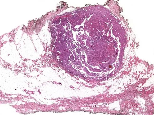 This histopathology image depicts a soft tissue lipomatous lesion illustrating a spindle cell/pleomorphic lipoma with a distinctive pseudoangiomatous pattern. The specimen is a subcutaneous adipose tissue fragment examined under bright-field light microscopy after Hematoxylin and Eosin staining. The architecture shows adipocytic components intermingled with alternating fibrous septa and spindle cells. Unusually, there are irregular, branching, slit-like spaces that mimic vascular channels; the spaces are lined by endothelial-like cells. In this case, subsequent immunohistochemistry demonstrates positivity of the lining cells for endothelial markers (e.g., CD31, CD34, ERG), consistent with a true angiomatous pattern, though in classic pseudoangiomatous lipoma these spaces reflect myofibroblastic or adipocytic stromal components rather than true neoplastic vessels. The adipocytes are mature, with minimal pleomorphism; the spindle cell component is bland and CD34 positive; focal calcifications or foamy histiocytes may be present. This pattern can be misinterpreted as a malignancy; awareness of this entity prevents overtreatment. Clinically, spindle cell lipomas commonly present as slow-growing, painless subcutaneous nodules in middle-aged adults; complete surgical excision yields excellent prognosis. The image is an educational example illustrating the spectrum of lipomatous tumors and the diagnostic pitfall of angiomatous mimicry in soft tissue neoplasms. This image supports histology teaching, differential diagnosis, and reporting.