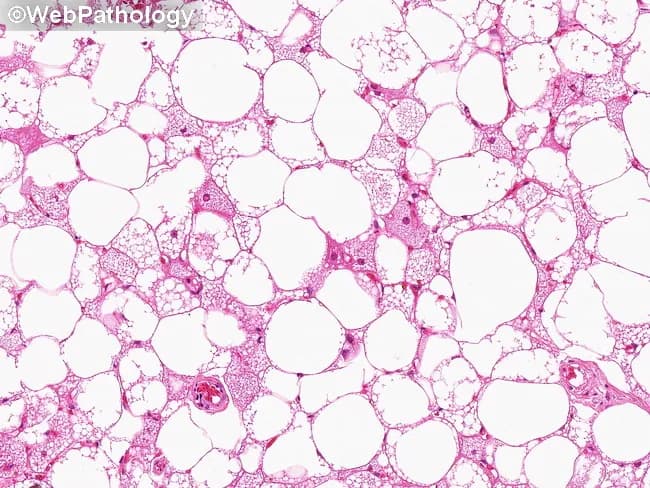 Imaging modality: Light microscopy of an H&E stained tissue section from a subcutaneous adipose lesion. Specimen: Excisional biopsy tissue of soft tissue mass. Location: Subcutaneous adipose tissue within the extremities or trunk, consistent with hibernoma lipoma-like variant. Visual features: The slide shows abundant univacuolated mature adipocytes with clear lipid droplets, minimal cytoplasm, and nuclei at the periphery, creating a pale, foamy appearance. The adipocytes are arranged in lobules and are separated by delicate fibrous septa. In this lipoma-like variant, the lesion is predominantly composed of mature white fat resembling a lipoma, with only scant brown fat differentiation or vacuolization. Vascular network: Thin capillary-rich stroma is present within septa, reflecting the vascular nature of brown fat components that may be variably represented. The overall histology lacks significant cellular atypia or lipoblasts. The sparse presence of multivacuolated cells, if present, and occasional mitochondria-rich cytoplasm may indicate residual brown fat differentiation, supporting a diagnosis within the spectrum of hibernoma rather than conventional lipoma. Clinical significance: Benign adipocytic tumor with lipoma-like histology; differentiating from liposarcoma is essential to avoid overtreatment; surgical excision is typically curative. Potential clinical use: diagnostic education, histopathology training, differential diagnosis evaluation, pathology atlases. Correlative imaging and clinical history enhance accuracy overall.