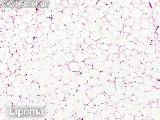 Imaging modality: Light microscopy of hematoxylin and eosin (H&E) stained formalin-fixed paraffin-embedded tissue section. Specimen: benign lipomatous lesion composed of mature adipocytes. Primary subject: adipose tissue within soft tissue (lipoma) with fibrous septa. Imaging perspective: histological cross-section through adipose lobules. The morphologic features: uniform round-to-oval adipocytes with small clear cytoplasm, peripherally placed nuclei, lacking significant cytologic atypia. Septa are relatively thin and occasionally show fibrous strands; no lipoblasts are evident. In this image, the background is comprised of many univacuolated adipocytes forming a lobulated architecture typical of lipoma. Compared to atypical lipomatous tumor/well-differentiated liposarcoma (ALT/WDL), this lesion shows minimal to no variation in adipocyte size, lack of hyperchromatic, atypical stromal cells in fibrous septa, and absence of necrosis or mitotic activity. Intramuscular lipoma variants may show atrophic skeletal muscle fibers adjacent to adipose tissue; in such cases, entrapped muscle fibers with hyperchromatic nuclei can mimic stromal atypia but lack lipoblasts and genetic alterations characteristic of WDL. The image corresponds to a benign lipomatous tumor and illustrates the core criteria used to distinguish lipoma from ALT/WDL in routine histopathology. Immunohistochemical or molecular markers, including MDM2 amplification status, can assist in differentiating ALT/WDL from benign lipomas in challenging cases. Accurate classification informs surgical margins and surveillance strategies.