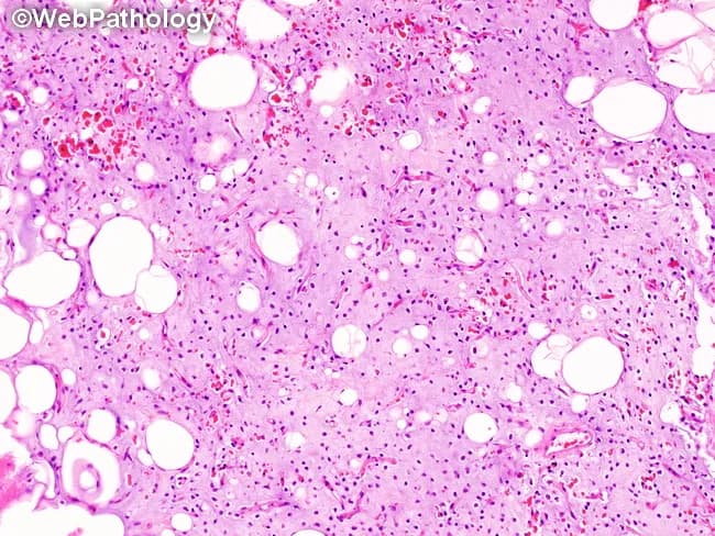 Imaging modality: Light microscopy histology of a soft tissue tumor. Specimen: formalin-fixed paraffin-embedded tissue section stained with Hematoxylin and Eosin (H&E). Anatomical context: deep soft tissue site (commonly extremities or trunk); precise origin not specified in the image. Histologic features include abundant myxoid matrix rich in acid mucopolysaccharides providing a pale, gelatinous background; scattered uniform non-adipocytic cells with spindle to stellate morphology organized in sheets; rare round cells; lipoblasts in various differentiation stages (small uni- or multi-vacuolated, signet-ring appearance) frequently located at tumor periphery; lipoblasts may be absent in some fields. Vascular pattern shows a delicate, plexiform network of thin-walled capillaries traversing the myxoid stroma, a hallmark distinguishing myxoid liposarcoma from myxoma and other myxoid neoplasms. Cytology reveals minimal atypia and low mitotic activity. The overall architecture is lobulated with myxoid septa. Diagnostic significance: this constellation—lipoblasts within a myxoid matrix and a plexiform capillary network—is characteristic of myxoid liposarcoma and supports definitive diagnosis; differential considerations include myxoid lipoma, myxoid pleomorphic sarcoma, and other liposarcoma subtypes; molecular testing for FUS-DDIT3 rearrangement can corroborate. Clinical utility: essential for surgical planning, prognosis assessment, and adjuvant therapy decisions; educational value for trainees; links to imaging and genetic studies; relevant to soft tissue sarcoma research databases.