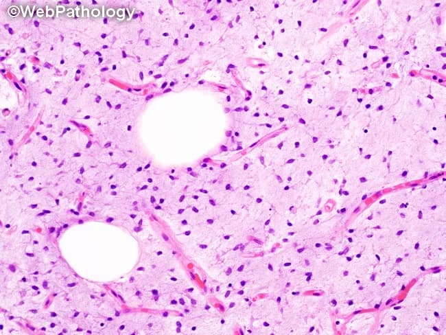 This histopathology image is a light-field microscopy view of a soft tissue tumor examined on formalin-fixed paraffin-embedded tissue stained with Hematoxylin and Eosin (H&E). The neoplasm shows an abundant myxoid (mucoid) extracellular matrix with numerous spindle, fusiform, and occasional stellate tumor cells. The cells display minimal cytologic atypia and there are no mitotic figures evident in the field, consistent with low-grade myxoid sarcoma features. A delicate, arborizing capillary network traverses the myxoid stroma and is a characteristic pattern in myxoid liposarcoma. Infrequent, non-diagnostic elements may be present, including extramedullary hematopoiesis and focal metaplasia with cartilage, bone, or smooth muscle; these incidental findings do not influence prognosis or therapeutic strategy. The lack of overt anaplasia helps distinguish this pattern from higher-grade sarcomas; however, when appreciable cellular atypia is encountered, myxofibrosarcoma or other myxoid sarcomas should be considered in the differential diagnosis. Clinically, the histology supports a myxoid liposarcoma diagnosis with favorable prognosis relative to high-grade variants, guiding surgical excision with adequate margins and potential adjuvant therapy based on location, size, and grade. Overall, the image exemplifies classic myxoid stroma with sparse, bland spindle cells and low mitotic activity, a diagnostically important pattern for soft tissue oncology and establish appropriate treatment planning.