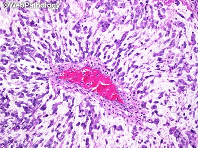 Histology image of a soft tissue mass showing features diagnostic of myxoid liposarcoma, high-grade (round cell) variant. The specimen is a tissue biopsy examined by light microscopy after Hematoxylin and Eosin staining. The architectural pattern reveals a prominent myxoid (mucoid) extracellular matrix with a delicate, arborizing capillary network radiating from vessels, a classic backdrop for myxoid adipocytic tumors. Intermixed are primitive, round to oval tumor cells arranged in cords and short trabeculae extending from the vascular core. The cells have scant cytoplasm, hyperchromatic nuclei, and mitotic activity is variably increased consistent with high-grade transformation. Occasional lipoblasts with scalloped cytoplasm may be present, highlighting adipocytic differentiation amidst the myxoid milieu. The surrounding stroma is relatively cellular in the high-grade areas, with less prominent lipogenic features compared with low-grade components. This image emphasizes the cellularity and architectural disruption associated with the round cell component, which portends a more aggressive clinical behavior and higher metastatic potential. Clinically, identification of high-grade cell populations in a predominantly myxoid liposarcoma influences prognosis and treatment planning, including surgical excision with wide margins and consideration of adjuvant chemotherapy or radiotherapy. Overall, the image exemplifies hallmarks used in pathology reports to classify liposarcoma subtype and grade for diagnostic accuracy.