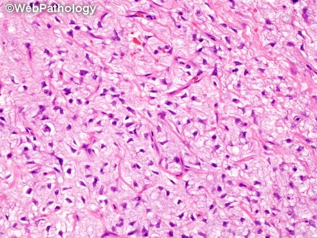 Histopathology image obtained via light microscopy of an H&E stained soft tissue specimen demonstrates the classic features of myxoid liposarcoma. The tumor is comprised of bland spindle-to-fusiform and stellate cells embedded in a abundant myxoid matrix, producing a pale basophilic, gelatinous background. The cellularity is moderate to low with uniform nuclei, minimal pleomorphism, and small inconspicuous nucleoli. A hallmark feature is the delicate arborizing/plexiform capillary network coursing through the myxoid stroma, which creates a lace-like vascular pattern. Sparse adipocytic lipoblasts may be present, often with cytoplasmic lipid vacuoles that indent nuclei. Mitotic figures are uncommon in well-differentiated areas but may be seen in higher-grade regions. The tumor margins are not well defined in this field; there may be a fibrous capsule or infiltrative growth into surrounding tissue. The combination of myxoid matrix with round-to-oval-to-spindle cells and a prominent vascular network is highly characteristic of myxoid liposarcoma and supports the diagnosis in the proper clinical context. Clinically, this histology correlates with a soft tissue sarcoma of extremities, often affecting the thigh or gluteal region, with potential for translocation t(12;16)(q13;p11) resulting in FUS-DDIT3 fusion. Diagnosis informs surgical management and adjuvant therapy decisions.