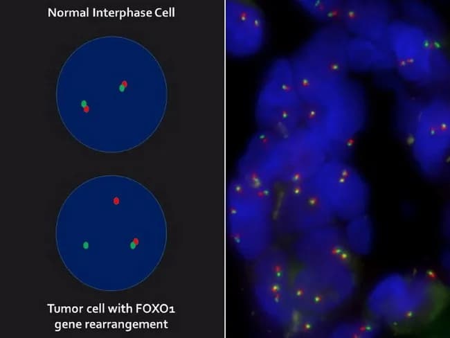 Imaging modality: Interphase Fluorescence in situ hybridization (FISH) using a FOXO1 break-apart probe on a formalin-fixed paraffin-embedded (FFPE) soft tissue tumor section with interphase nuclei. Anatomical location: alveolar rhabdomyosarcoma (ARMS) tissue, FOXO1 genetic locus at 13q14.11. In normal interphase cells, the green and red FOXO1 probe signals co-localize as fused signals, representing two non-rearranged 13q14.11 loci. In tumor cells with FOXO1 rearrangement, signal pattern changes to one green/red fusion signal (non-rearranged copy) plus one separate green signal and one separate red signal, corresponding to a rearranged allele with one break-apart. The right panel shows dispersed small signals from numerous nuclei within tumor tissue; the left panel demonstrates the contrasting patterns in normal versus tumor interphase cells. This pattern is diagnostic for FOXO1 gene rearrangements, typically resulting from PAX3-FOXO1 or PAX7-FOXO1 fusion transcripts in ARMS. The diagnostic significance: confirms molecular subtype of rhabdomyosarcoma; supports prognosis and therapeutic decisions, including risk stratification and potential targeted therapy considerations. The technique is robust for detecting cryptic rearrangements in FFPE tissues; limits include tissue quality and signal overlap. Clinical correlation with histology reveals alveolar morphology with alveolar pattern; differential diagnoses include embryonal RMS and other sarcomas lacking FOXO1 rearrangement. This image exemplifies break-apart FISH interpretation and is useful for education, quality control, and diagnostic reference.