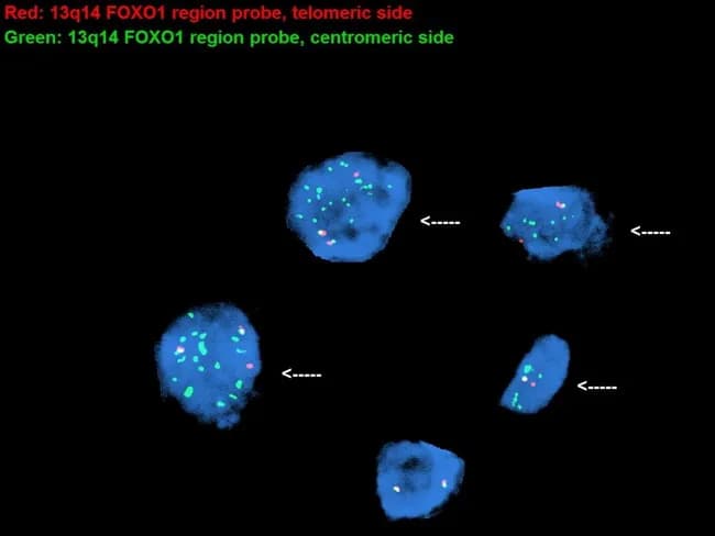 Fluorescence in situ hybridization (FISH) image using a red FOXO1 region probe and a green FOXO1 region probe (break-apart configuration) was performed on interphase tumor cells from a case of alveolar rhabdomyosarcoma. The predominant pattern shows a PAX7-FOXO1 rearrangement with translocation t(1;13)(p36;q14), as indicated by separation of red and green signals at the fusion locus; amplification of the fusion gene is present, a feature more often associated with PAX7-FOXO1 than PAX3-FOXO1. The bottom cell is a normal interphase nucleus that lacks translocation; it displays two co-localized red-green signal pairs corresponding to two intact FOXO1 loci at 13q14.11. The arrows highlight the rearranged signals, consistent with oncogenic PAX7-FOXO1 fusion driving alveolar rhabdomyosarcoma biology. Observed signal patterns include break-apart separation and signal amplification in tumor cells, with normal control patterns in non-neoplastic cells. This assay provides definitive cytogenetic evidence of the FOXO1 rearrangement, correlating with molecular subtype, prognosis, and potential therapeutic stratification. These findings support a diagnosis of alveolar rhabdomyosarcoma and underscore the clinical value of PAX7-FOXO1 testing for diagnostic confirmation, risk stratification, and targeted therapy planning. This image is annotated with arrows and uses red-green color coding to distinguish rearranged from non-rearranged loci and to illustrate interphase chromosomal dynamics for education.