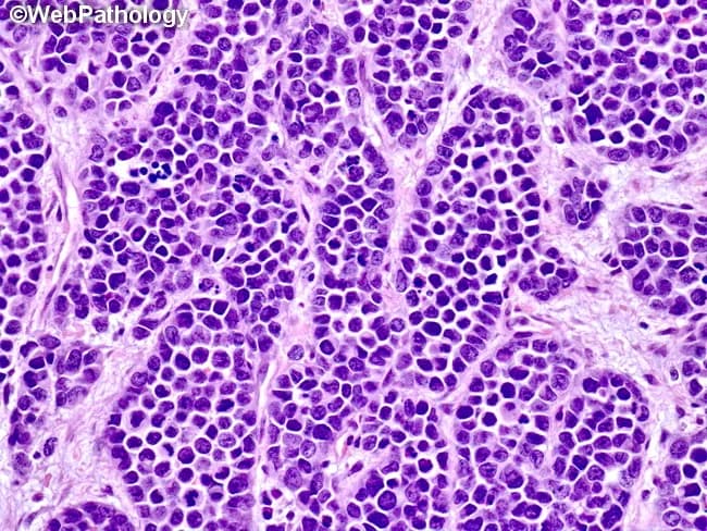 Alveolar rhabdomyosarcoma (ARMS) histology image demonstrating malignant soft tissue tumor composed of irregular aggregates of poorly differentiated round to oval cells. Tumor nests are separated by thick, hyalinized fibrous septa containing dilated capillaries and small vessels. Central cells within nests retain intercellular cohesion, resulting in partial or immature alveolar-like architecture rather than a fully formed alveolar pattern. The high nuclear-to-cytoplasmic ratio, hyperchromatic round to oval nuclei, and scant cytoplasm characterize these small round blue cells. Occasional mitotic figures and necrotic debris may be evident in aggressive neoplasms. Immunophenotypically, ARMS typically shows positivity for myogenin and MyoD1, desmin, and other skeletal muscle differentiation markers; cytogenetics often reveals PAX3-FOXO1 or PAX7-FOXO1 translocations. Clinically this histology correlates with high-grade, aggressive pediatric/adolescent soft tissue sarcoma with a propensity for metastasis. Differential considerations include embryonal rhabdomyosarcoma (ERMS), Ewing sarcoma/undifferentiated round cell sarcoma, synovial sarcoma, and nonrhabdomyoblastic small round blue cell tumors. The image highlights diagnostic features relevant to surgical pathology, oncology, and pathology education. This morphological snapshot supports diagnostic pathology workflows, guiding immunohistochemistry panels and molecular testing. Relevance spans medical education, case review, and research on rhabdomyosarcoma subtypes and alveolar architecture. Clinical utility includes guiding targeted IHC panels, FISH/MET testing, and treatment planning for patients.