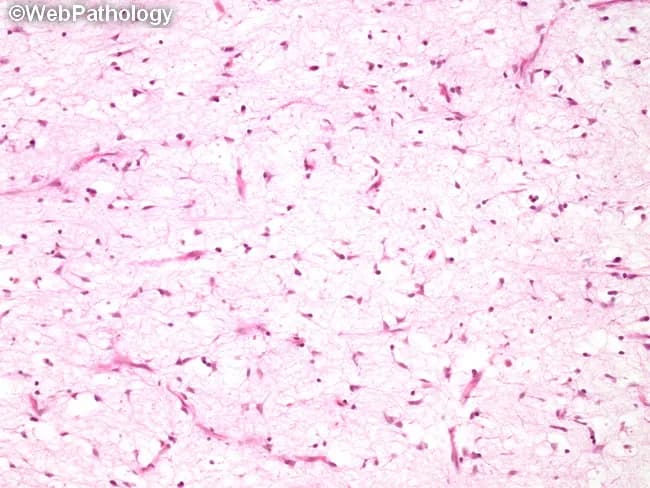 Histopathology micrograph of a neurofibroma on hematoxylin and eosin stained tissue shows a myxoid to mucinous stroma with sparsely cellular regions and interlacing wispy spindle cells. Neoplastic Schwann cells possess slender, elongated, often wavy nuclei and are embedded in a loose matrix with few collagen fibers. Axons are variably present within the tumor, a feature that supports a neural origin. EMA-positive perineurial-like cells outline some cell clusters, and CD34-positive spindle fibroblast-like cells are intermingled with scattered mast cells. The myxoid matrix ranges from densely mucoid to more watery, and hypocellular variants are recognized as myxoid neurofibroma. Organoid pseudo-Meissnerian structures may be seen, providing a helpful diagnostic clue toward neurofibroma. Notable vascularity and a pattern of mild-to-moderate orientation of spindle cells further support a nerve sheath tumor, while the absence of a true capsule is typical. The lesion can mimic myxoma or myxoid liposarcoma when cellularity is low, but the presence of axons and the immunophenotype (S100 positive Schwann cells; EMA positive perineurial cells; CD34 positive fibroblasts) favor neurofibroma. Clinically, neurofibromas are associated with NF1 and can occur sporadically; complete excision is typically curative for localized tumors, though NF1 carries a risk of malignant transformation to MPNST. Immunoprofile aids diagnosis.