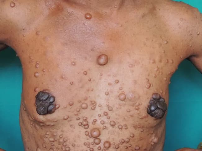 Imaging modality: Clinical photography of a living patient. Anterior trunk and upper torso view showing numerous cutaneous neurofibromas characteristic of Neurofibromatosis type 1 (NF1, von Recklinghausen disease). Primary subject: skin and subcutaneous tissue involvement with widespread, discrete nodules of varying size on the chest, abdomen, face, and limbs. Lesion morphology includes sessile and pedunculated, dome-shaped nodules that are firm, non-tender, and skin-colored to brown. Two prominent bilateral nipple-areola complex neurofibromas are evident, a finding described as uncommon but highly associated with NF1. The size range observed in this field image is approximately 0.2–2.5 cm. Additional cutaneous manifestations may include cafe-au-lait macules (not clearly visible here) and other soft tissue lesions. The clinical diagnosis is supported by family history and biopsy confirming NF1. Plexiform neurofibromas, when present, are virtually diagnostic of NF1 and warrant ongoing oncologic and neurosurgical surveillance due to potential malignant transformation to malignant peripheral nerve sheath tumors (MPNST). This photograph is valuable for dermatology education and for illustrating characteristic lesion distribution, nomenclature (neurofibroma, plexiform neurofibroma, café-au-lait spots, Lisch nodules), and differential considerations (schwannomatosis, multiple benign cutaneous tumors). Imaging aids in monitoring lesion burden and guiding genetic counseling and clinical management.