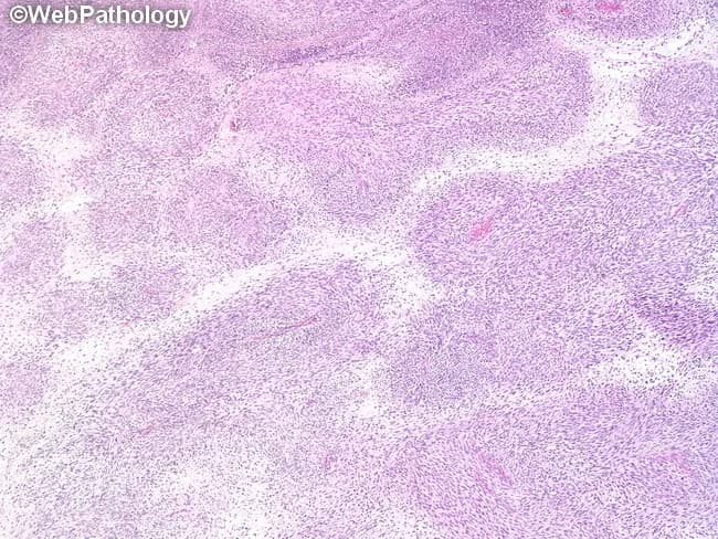This Histopathology image depicts a malignant peripheral nerve sheath tumor (MPNST) in a soft tissue/nerve-associated mass. The tumor is highly cellular, with spindle-shaped neoplastic cells arranged in intersecting fascicles and occasional palisading and whorled patterns characteristic of nerve sheath neoplasia. Individual cells are predominantly monomorphic with slender, elongated morphology; nuclei are comma-shaped, wavy or buckled and hyperchromatic, and cytoplasm is indistinct and pale. Some tumor areas show plump oval to rounded nuclei, reflecting variable cellular differentiation. The growth demonstrates alternating hypercellular regions and hypocellular zones embedded in a myxoid stroma, indicating mucopolysaccharide-rich extracellular matrix. Focal nuclear palisading and regionally organized whorls resemble tactoid-like differentiation, a feature described in MPNST. Hyalinized cords and nodules may be present; there may be scant mitotic activity in some fields. Vessel wall involvement by tumor cells is noted in places, illustrating aggressive infiltration. Overall, the lesion lacks uniform whorling of benign schwannomas and exhibits malignant cytologic features with heterogeneous architecture. Immunophenotypic correlation (e.g., SOX10/S100) is helpful for confirmation in practice, but not visible here. This histologic profile supports a diagnosis of MPNST and carries important prognostic and therapeutic implications, including surgical excision with clear margins and consideration of adjuvant therapy for patient-specific management and follow-up.