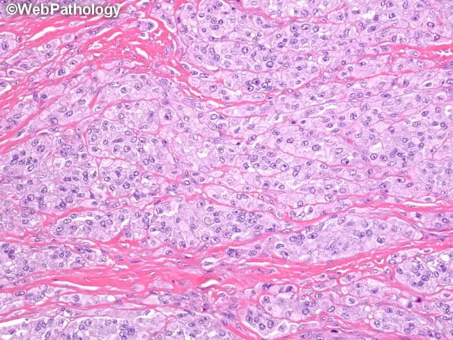 Histology: Light microscopy with Hematoxylin and Eosin stained section of soft tissue demonstrating a malignant spindle cell neoplasm. Tumor cells are fusiform to polygonal, organized in dense solid nests and broad fascicles separated by a conspicuous fibrous stroma. The fibrous septa extend between tumor nests and frequently appear to merge with adjacent tendons and aponeuroses, reflecting the tumor's intimate relationship with peri-tendinous structures. Cells show eosinophilic cytoplasm and elongated, ovoid nuclei with evenly distributed chromatin; occasional nuclear pleomorphism and mitotic activity may be present. Matrix is scant, with interstitial fibrous tissue creating a ribbon-like network that contributes to the characteristic appearance. In some fields, cells may contain clear cytoplasm due to glycogen-rich content, a feature that contributes to the name 'clear cell.' The overall pattern is consistent with a malignant spindle cell sarcoma with melanocytic differentiation. Immunophenotype (not shown here) often demonstrates S-100 positivity and sometimes HMB-45, helping distinguish from other soft tissue sarcomas; molecular testing typically reveals EWSR1-ATF1 fusion arising from t(12;22). Clinically, this lesion arises in extremities and may mimic melanoma, or other sarcomas. Definitive classification requires integrated histology, immunohistochemistry, and molecular genetics for definitive diagnosis and optimal management. Correlation with clinical presentation enhances diagnostic accuracy.