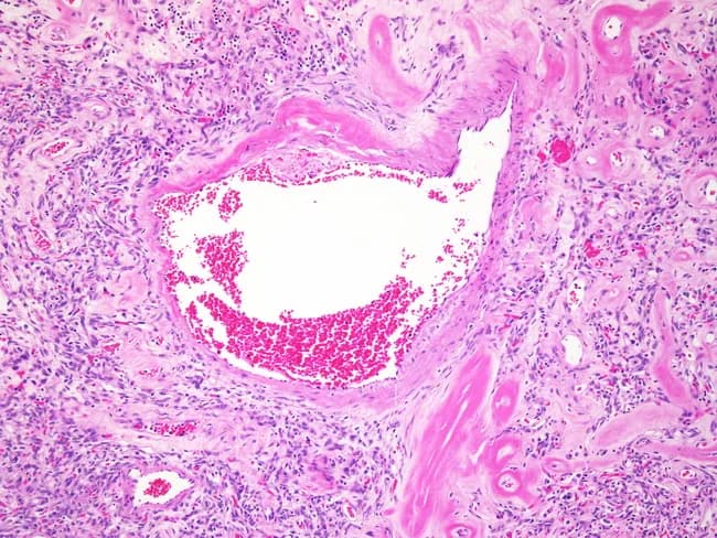 This histology slide is a hematoxylin and eosin stained cross-section of vascular tissue showing an occlusive intraluminal thrombus within a small vessel. The thrombus is erythrocyte-rich with scattered pale eosinophilic fibrin strands, producing a heterogeneous red-pink to pale-white appearance within the lumen. The vessel wall displays mild intimal thickening and subtle edema of the surrounding media. A perivascular inflammatory infiltrate, comprising neutrophils and small lymphocytes, is embedded in loose fibrous stroma surrounding the vessel. There is no overt necrosis, granulomatous inflammation, or malignant cells detected in the observed field. Adjacent extracellular matrix appears relatively loose with modest collagen deposition, compatible with chronic inflammatory change. Overall, the image demonstrates a thrombotic vasculopathy pattern with secondary inflammatory response. Clinically relevant to thrombosis risk assessment, hypercoagulable states, inflammatory vasculitis, or vascular injury, this finding requires correlation with patient history and laboratory tests. The staining highlights cellular detail, fibrin deposition, and vessel-wall integrity, supporting differential diagnoses such as acute thrombosis, embolic occlusion, and vasculopathic processes, and aiding pathologic correlation and therapeutic decision-making.