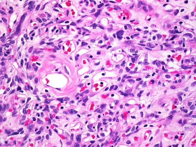 Imaging modality: Light microscopy; Technique: Hematoxylin and eosin staining; Specimen: Tissue biopsy; Magnification: 400x. The slide depicts a granular inflammatory tissue with chronic granulomatous features. Epithelioid histiocytes are arranged in nodular clusters, interspersed with multinucleated giant cells. The background shows a mixed inflammatory infiltrate dominated by small lymphocytes and occasional plasma cells. Blood vessels with mild perivascular inflammation are present, and the stromal framework appears fibrous in places. In several fields there are well-demarcated granuloma-like aggregates, while elsewhere the architecture is disrupted by focal necrotic debris and amorphous pink extracellular matrix. Notable features include coalescing macrophage-rich nodules and a few eosinophils; occasional foamy macrophages may be seen. The overall pattern is compatible with chronic granulomatous inflammation. Pathological significance: suggests a granulomatous process, prompting differential diagnoses such as infectious etiologies (mycobacterial, fungal) or noninfectious conditions like sarcoidosis or foreign-body reaction. Recommended ancillary studies: Ziehl-Neelsen or acid-fast stains, Gomori methenamine silver or PAS stains, fungal cultures, and targeted immunohistochemistry as indicated. Clinical correlation with patient history, imaging, and microbiology is essential for etiologic determination and guiding management. Clinical utility: this image serves as an educational reference for understanding granulomatous pathology in biopsy specimens and for teaching interpretation of epithelioid histiocytes, giant cells, and necrotic changes.