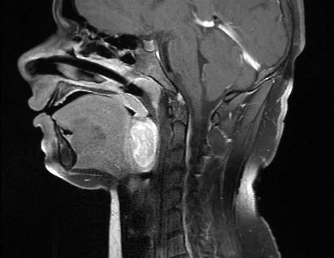 Magnetic resonance imaging (MRI) of the head and neck with gadolinium contrast demonstrates a soft-tissue mass within the oropharyngeal region anterior to the base of the tongue. The lesion is isointense to muscle on T1-weighted sequences and hyperintense on T2-weighted images, with marked, homogeneous post-contrast enhancement. The mass displays a discrete margin with the adjacent base of tongue, indicating a defined lesion abutting but separable from surrounding musculature; there is no gross invasion of the tongue musculature seen on this sagittal plane. Relative anterior orientation compared with prior radiographs suggests progression or resection planning implications. The imaging appearance supports a spindle-cell neoplasm with high vascularity and extracellular water content, consistent with monophasic synovial sarcoma in the clinical context. The findings are non-cystic, non-fatty, and show no frank calcifications on these sequences. The mass was subsequently resected, and histopathology confirmed monophasic synovial sarcoma; correlative molecular testing for SYT-SSX fusion can be pursued for definitive subtyping. Clinically, these features assist surgical planning, radiation therapy considerations, and prognosis evaluation. Differential diagnosis includes other soft-tissue sarcomas of the oropharyngeal region (rhabdomyosarcoma, fibrosarcoma, malignant peripheral nerve sheath tumor) and less likely inflammatory or infectious processes; radiologic-pathologic correlation is essential. MRI remains a critical tool for preoperative mapping and post-therapeutic surveillance in head-and-neck sarcomas.