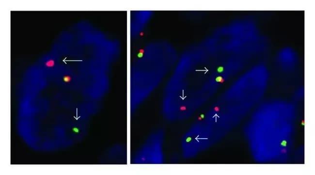 Fluorescence in situ hybridization (FISH) on formalin-fixed paraffin-embedded tissue was performed using a dual-color SS18 (SYT) break-apart probe to detect the characteristic rearrangement seen in synovial sarcoma. The probe targets the 18q11.2 region harboring the SS18 gene. In a normal, non-rearranged cell, the green proximal and orange distal signals overlap to create a fused signal, representing two intact SS18 loci. In cells carrying the translocation t(X;18)(p11.2;q11.2), the probes separate, yielding distinct green and orange signals with loss of fusion; the image panels show examples where one fusion signal coexists with separate green and orange signals, as indicated by arrows. This break-apart pattern is pathognomonic for SS18 rearrangement when interpreted in the appropriate histologic and immunophenotypic context and supports a diagnosis of synovial sarcoma. The assay can be performed directly on FFPE material and complements routine histology and immunohistochemistry, particularly when conventional karyotyping is limited by specimen quality. Interpretation requires adequate tumor cell content and careful counting of nuclei to avoid artifactual signals. Clinically, detection of SS18 rearrangement informs differential diagnosis, influences treatment planning, and has prognostic relevance in soft tissue sarcomas with SYT-SSX fusion. This pattern complements histology and immunohistochemistry, supporting biopsy-based diagnosis and targeted systemic therapy decisions in practice.