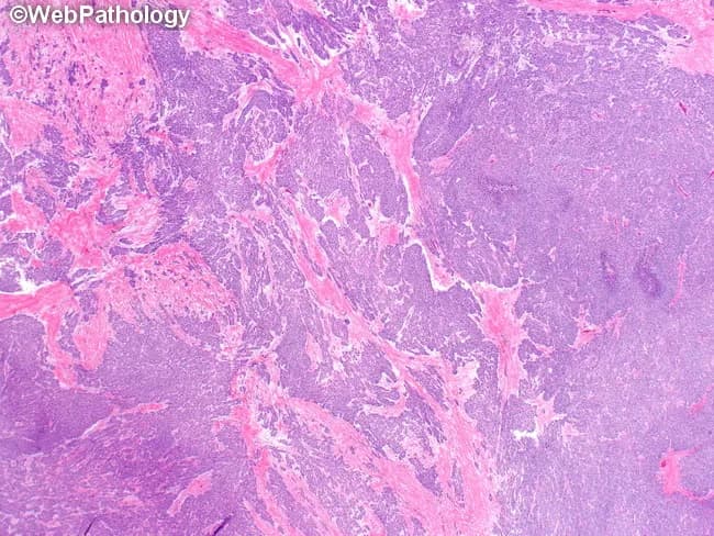 This light-microscopy histology slide shows Desmoplastic small round cell tumor (DSRCT) morphology. Hematoxylin and eosin (H&E) staining reveals sharply demarcated nests and anastomosing trabeculae of small round blue cells with scant cytoplasm and hyperchromatic nuclei, embedded in a densely desmoplastic fibrous stroma. The tumor cells exhibit brisk mitotic activity and occasional rosette-like patterns. The desmoplastic background contains abundant collagen with prominent vascularity, contributing to the fibrous, hyalinized appearance. While not visible by this stain alone, typical immunophenotype includes coexpression of epithelial and mesenchymal markers (cytokeratins, EMA) and desmin in a dot-like perinuclear pattern; WT1 positivity supports the diagnosis. Molecular confirmation commonly shows EWS-WT1 fusion from t(11;22)(p13;q12). Clinically, DSRCT is an aggressive small round cell sarcoma arising primarily in the abdomen or pelvis with potential for peritoneal spread and multicentric involvement; prognosis is poor despite multimodal therapy. This image is valuable for educational purposes, illustrating the characteristic nest-desmoplastic matrix contrast and serving as a reference in differential diagnosis against Ewing sarcoma/PNET, neuroblastoma, and rhabdomyosarcoma. It underscores the need for ancillary studies to confirm diagnosis in pathology practice. This image emphasizes classic DSCRT morphology and the essential role of molecular testing in confirming the EWS-WT1 translocation. This makes it valuable for research and education.