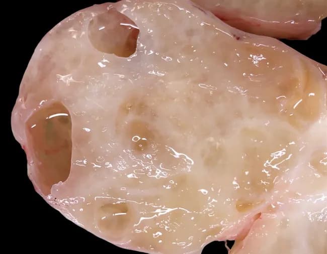 Gross pathology photograph of a sectioned thigh muscle showing an intramuscular myxoma. The specimen is a large, well-circumscribed soft tissue mass with a pink-tan, gelatinous cut surface and delicate fibrous septa. Small cystic areas contain mucoid fluid, reflecting abundant myxoid extracellular matrix. The lesion typically ranges from several centimeters up to 15 cm in greatest dimension and tends to blend with surrounding muscle rather than forming a dense capsule. On gross inspection, variability in myxoid content may produce areas that appear more solid or fibrous. The tumor is usually located within the muscle fibers of the thigh, as described in middle-aged adults, and may infiltrate adjacent muscular compartments without a true anatomic capsule. This macroscopic appearance correlates with the histologic hallmark of intramuscular myxoma: a hypocellular lesion composed of spindle to stellate cells embedded in a loose, mucopolysaccharide-rich matrix. Diagnostic significance lies in distinguishing this benign entity from myxoid sarcomas, which show higher cellularity, mitotic activity, and more complex vascular patterns. Complete surgical excision is curative in most cases, with low recurrence when margins are clear. This image illustrates the essential gross features used in initial pathologic assessment and downstream radiologic-histologic correlation.