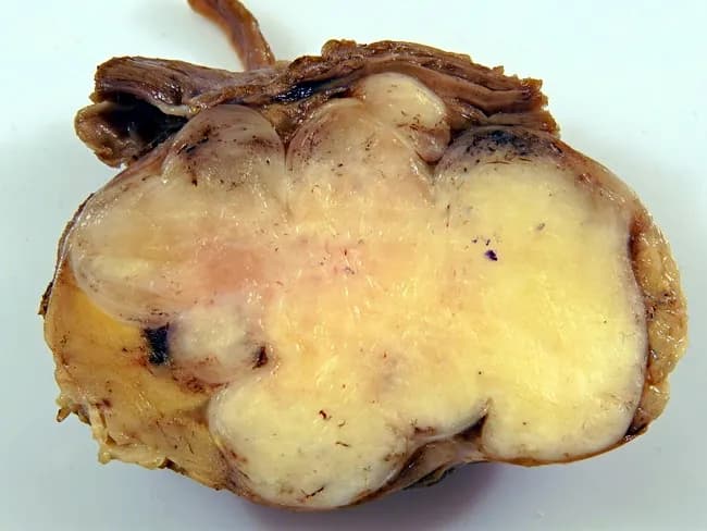 Gross-pathology view of an 8 cm intramuscular myxoma within the thigh musculature from a middle-aged man. This specimen demonstrates a circumscribed, pale, yellow-white mass with a gelatinous to mucoid cut surface in classic myxoid variants; in collagen-predominant foci the cut surface is more fibrous and tan. The lesion infiltrates adjacent skeletal muscle despite a deceptively well-defined external margin. It measures approximately 8 cm in greatest dimension and resides within a single or deep compartment of the thigh, separating but not erupting into surrounding soft tissue. Histologically, the tumor shows abundant myxoid matrix rich in acid mucopolysaccharides interlaced with small spindle or stellate cells; collagenized areas impart a fibrous texture. Although macroscopically infiltrative, such intramuscular myxomas are benign and lack overt cellular atypia or high mitotic activity. Diagnostic significance rests on distinguishing these lesions from myxoid sarcomas such as myxoid liposarcoma or myxofibrosarcoma, nodular fasciitis with myxoid change, or fibromatosis. Clinically, patients present with a slow-growing, painless mass in the proximal or mid-thigh in middle-aged adults; imaging (MRI) may show a well-defined, T2-hyperintense lesion with a myxoid halo, but histology is definitive. Complete surgical excision yields excellent prognosis; recurrence is uncommon but increases with incomplete resection. This image is a gross-pathology photograph documenting the tumor’s macroscopic appearance and its infiltration pattern.