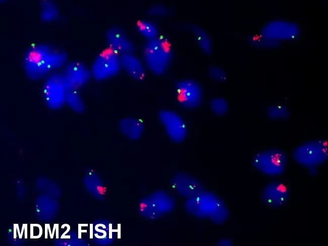 Dual-color fluorescence in situ hybridization (FISH) image illustrating MDM2 gene amplification (red) with the chromosome 12 centromere reference probe CEP12 (green) in a soft tissue lipomatous tumor. Nuclei display multiple red signals indicating MDM2 copy number gain on chromosome 12q15, characteristic of atypical lipomatous tumor/well-differentiated liposarcoma (ALT/WDL) and its dedifferentiated counterpart. The green CEP12 signals provide a stable chromosomal reference, enabling robust interpretation of amplification relative to centromeric control. This pattern supports the diagnosis of liposarcoma rather than benign lipomatous lesions, which typically lack MDM2 amplification. Compared with MDM2 immunohistochemistry, FISH offers higher sensitivity and specificity, reducing false positives that can occur with protein-based assays. A small minority of spindle cell or pleomorphic lipomas may exhibit MDM2 positivity due to polysomy of 12q; however, the amplification signal in ALT/WDL is usually robust and well‑defined. Clinically, MDM2 FISH is particularly valuable in older patients (>50 years), in deep-seated or large lesions (>10 cm), retroperitoneal or intraabdominal lipomatous tumors lacking overt atypia, and in recurrent tumors where accurate classification guides management. This image illustrates the decisive genetic alteration underlying a liposarcoma spectrum and informs diagnostic, prognostic, and therapeutic considerations. Credit: Dr. Runjan Chetty.