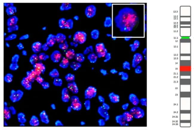 This molecular pathology image is a dual-color fluorescence in situ hybridization (FISH) study performed on FFPE soft tissue tumor tissue from a dedifferentiated liposarcoma (DLPS). The primary target probes label the MDM2 gene locus on chromosome 12q15 in red, while the reference CEP12 probe specific for the chromosome 12 centromere is shown in green. Nuclei are counterstained blue (DAPI). The image demonstrates high-level amplification of MDM2, evidenced by multiple red signals per nucleus in a background of predominantly two green CEP12 signals; some nuclei display clustered red signals, consistent with focal gene amplification typical of DLPS. The inset highlights a representative cell with prominent red MDM2 signals adjacent to green centromeric signals, illustrating signal co-localization and increased copy number. This amplification profile aligns with known oncogenic drivers of liposarcoma, particularly the 12q13-15 amplicon that also harbors CDK4 and HMGA2; GLI1 and DDIT3 may be variably overexpressed. MDM2 amplification aids diagnostic discrimination from benign lipomas and other sarcomas, and supports a diagnosis of DLPS in morphologically ambiguous cases. Potential pitfalls include signal overlap, copy-number heterogeneity, and FFPE-related artifacts; accurate interpretation requires counting multiple nuclei and cross-referencing with histology and immunohistochemistry. This image, derived from Gambella et al., demonstrates the utility and limitations of FISH for detecting MDM2 amplification in liposarcoma.