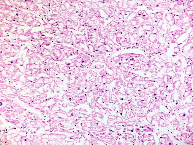 Imaging modality: Light microscopy of hematoxylin and eosin stained cardiac tissue from human autopsy. Specimen: Left ventricular myocardium (cardiac muscle) with hypertrophy. View: Low magnification histology. Key features: hypertrophied cardiomyocytes with pronounced cytoplasmic vacuolization representing lipid-laden lysosomes from globotriaosylceramide (Gb3) accumulation characteristic of Fabry disease. The tissue architecture shows preserved overall myocardial laminar arrangement but with clear cytoplasmic clear spaces within myocytes. Nuclei appear relatively preserved. Electron microscopy would show myelin figures (zebra bodies) not visible on light microscopy. Clinical significance: This histopathology supports Fabry cardiomyopathy in a patient with X-linked alpha-galactosidase A deficiency; correlation with systemic Fabry manifestations (angiokeratomas, hypohidrosis, renal involvement) and genetic testing (GLA gene mutations) is essential. Diagnostic implications: In differential diagnosis of left ventricular hypertrophy, especially in younger males, histology showing intracellular vacuolization without substantial amyloid deposition or glycogen accumulation points toward sphingolipidoses such as Fabry disease. Potential use cases: educational resource demonstrating lysosomal storage cardiomyopathy; reference for pathology, cardiology, medical education, and genomic medicine; can guide differential with Pompe disease and Danon disease. Analytical relevance: Helps illustrate genotype-phenotype relationships via Gb3 accumulation and α-Gal A deficiency. This description emphasizes myocardial involvement in Fabry disease, reinforcing the need for multidisciplinary evaluation.
