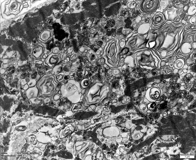 Transmission electron microscopy image of human cardiac tissue from a Fabry disease case shows hallmark lysosomal storage inclusions within cardiomyocytes and vascular endothelium. At high magnification, numerous lysosomes contain concentric lamellae forming zebra bodies or myelin figures, reflecting accumulation of globotriaosylceramide (Gb3) due to alpha-galactosidase A deficiency. The ultrastructural features include enlarged, electron-dense lysosomes with alternating dense and light lamellae and cytoplasmic vacuolization, consistent with sphingolipid storage. The tissue plane focuses on myocardial cells and microvascular elements; scale bar indicates ~1 μm, with magnification around 7000×, enabling subcellular visualization of organelle pathology. This image demonstrates the intracellular bottleneck of Gb3 trafficking that underlies multi-organ involvement in Fabry disease, including cardiac hypertrophy, renal failure, and cerebrovascular events. Clinically, these findings support diagnosis when correlated with enzyme assay and genetic testing, and they illustrate the impact of early enzyme replacement therapy on prognosis. Postmortem, such ultrastructural evidence aligns with progressive cardiomyopathy and vascular Gb3 deposition. The image is a valuable teaching resource for medical students, pathologists, and researchers, capturing the microscopic basis of Fabry-related cardiomyopathy and the rationale for disease-specific management and prognosis. Interpretation should be integrated with clinical history, biochemical Gb3 quantification, and genetic confirmation for comprehensive care planning.