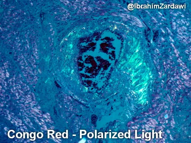 Imaging modality and technique: Light microscopy of Congo red-stained cardiac tissue examined under polarized light. Primary subject: Cardiac amyloidosis with amyloid deposition in the vascular wall. Specimen type: Cardiac tissue biopsy specimen. Imaging perspective: Polarized-light evaluation of Congo red–stained sections. Visual features: Irregular, eosinophilic, amorphous extracellular deposits confined to small- to mid-sized vessel walls within the myocardium; deposits appear as dense, salmon-pink material on routine brightfield and exhibit characteristic apple-green birefringence under polarized illumination. Diagnostic significance: Congo red positivity with apple-green birefringence confirms amyloid deposition in heart tissue, supporting a diagnosis of systemic amyloidosis with cardiac involvement. This finding is clinically relevant because myocardial amyloid deposition can cause restrictive cardiomyopathy with diastolic dysfunction and heart failure; identification guides systemic workup for AL (light-chain) vs ATTR (transthyretin) etiologies, and informs prognosis and treatment strategies. Differential considerations: Non-amyloid eosinophilic deposits or pigmentations would lack Congo red positivity and birefringence; however, the combination of Congo red staining and birefringence is consistent with amyloidosis. Clinical correlation: Correlate with echocardiography, cardiac MRI, serum free light chains, immunohistochemistry, and genetic testing as indicated.