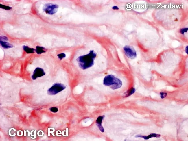 This histology image depicts human cardiac tissue (myocardium) stained with Congo Red and examined under bright-field microscopy. The image highlights extracellular, eosinophilic amyloid deposits that encircle and encroach upon individual cardiomyocytes (perimyocytic/interstitial deposition). The deposits appear as amorphous, orange to salmon-pink material on Congo Red, consistent with amyloid. When the same tissue is examined under polarized light, Congo Red–positive material exhibits characteristic apple-green birefringence, a pathognomonic feature of amyloidosis. The prevailing pattern is perimyocytic, with amyloid accumulating in the interstitium around myocytes and near small vessels, potentially contributing to myocardial stiffness and diastolic impairment. Histologic architecture shows preserved cellular morphology of myocytes with basophilic nuclei contrasted against the pink-red amyloid matrix. This image is diagnostic for cardiac amyloidosis on biopsy and would typically prompt typing (AL vs ATTR) by immunohistochemistry or mass spectrometry, as well as correlation with serum free light chains or transthyretin testing. Clinically, such infiltration predisposes to restrictive cardiomyopathy, diastolic dysfunction, arrhythmias, and heart failure symptoms. This slide underscores the utility of Congo Red staining in identifying myocardial amyloid deposits and the diagnostic value of polarized light birefringence for definitive confirmation. Useful for teaching, differential diagnosis, and research into infiltrative cardiomyopathies and treatment monitoring.