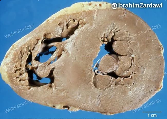 Gross pathology photograph of a human heart in transverse mid-ventricular section, illustrating macroscopic features of cardiac amyloidosis. The myocardium appears pale, waxy, and firm, consistent with amyloid deposition replacing normal myocardial tissue. Concentric left ventricular hypertrophy is evident, with thickened LV wall while chamber cavity is reduced in caliber relative to normal. The right ventricle is less involved in this cut, and the endocardial surfaces show smooth contour without focal infarction. These findings reflect an infiltrative cardiomyopathy process where extracellular amyloid proteins infiltrate the interstitium, causing stiff, noncompliant myocardium and diastolic dysfunction. The gross resemblance to waxy infiltration, in combination with preserved coronary architecture, supports a diagnosis of cardiac amyloidosis rather than primary hypertrophic hypertrophy or hypertensive remodeling alone. This image serves educational and diagnostic contexts for surgical pathology, cardiology, and radiology reviews, and is useful for teaching about late-stage restrictive cardiomyopathy. In clinical practice, these macroscopic cues prompt confirmatory microscopic evaluation, immunohistochemical typing, and systemic evaluation for underlying plasma cell dyscrasia or transthyretin amyloidosis. Potential uses include medical education, pathology correlation, radiology-pathology conferences, and research on infiltrative heart disease and cardiomyopathy phenotypes. Correlative clinical data and ancillary testing guide prognosis and treatment choices in suspected infiltrative cardiomyopathy patients today.