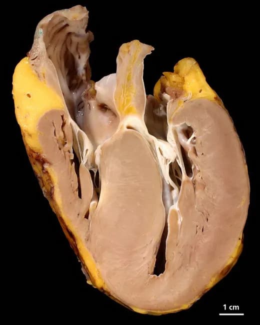 Gross pathology photograph of a human heart obtained from a 53-year-old female with hypertrophic cardiomyopathy. Modality: Gross pathology photography; specimen is a fixed, whole-heart cross-section. Anatomical orientation reveals a transverse cut through the ventricles revealing markedly thickened left ventricular walls and an enlarged, fibrous interventricular septum with reduction of the left ventricular cavity. Epicardial adipose tissue is variably present along the outer surface. Internal papillary muscles are visible, and the right ventricle shows relatively preserved wall thickness compared with the hypertrophied left ventricle. The myocardial wall appears densely myocardiac with homogeneous pale to tan coloration consistent with fixation. The image scale bar indicates 1 cm for reference. The gross morphology is typical of hypertrophic cardiomyopathy, where asymmetric septal hypertrophy can cause decreased LV cavity volume and potential outflow tract obstruction; however, assessment of obstruction requires echocardiography or MRI. This specimen demonstrates the hallmark feature of disproportionate septal thickening relative to the posterior wall. Clinically, hypertrophic cardiomyopathy elevates risk for arrhythmias, syncope, and sudden cardiac death, particularly in middle-aged patients. The image is useful for educational illustration of cardiac remodeling in HCM, correlating macroscopic anatomy with underlying myocardial disarray and genetic etiologies. Relevant for pathology, cardiology, and medical education contexts worldwide.