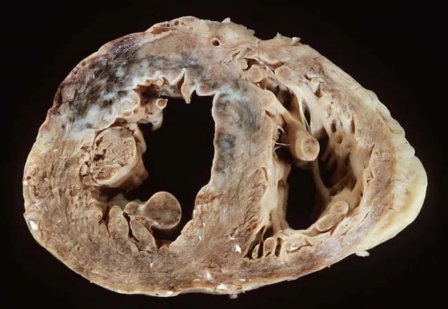Gross pathology image of an extracted human heart cut in transverse section to expose the ventricles. Modality: macroscopic inspection during autopsy or surgical specimen; technique: serial cross-sectional dissection of the ventricles revealing infarcted and fibrotic zones. Anteriorly in the anteroseptal left ventricular wall there is a partially healed infarction with thinning, scar formation and mottled pallor consistent with prior ischemic injury. In the anterolateral/lateral left ventricular wall, a subacute infarct is evident, showing fibrous connective tissue with adjacent edema and discoloration. The right ventricle demonstrates marked fibrosis and myocardial remodeling with patchy, firm trabeculations. Overall, the myocardium exhibits biventricular hypertrophy with thickened walls and increased myocardial mass; left ventricular wall thickening may appear concentric but can reflect remodeling from chronic hypertension and ischemic injury. The combination of age (82-year-old female) and cardiovascular risk factors-smoking, essential hypertension, dyslipidemia—supports a long-standing coronary atherosclerotic disease. Notable clinical context includes postmenopausal elevation of coronary risk. The image highlights the structural consequences of myocardial infarction, scar replacement, and concentric/eccentric hypertrophy in the setting of ischemic cardiomyopathy. This resource is useful for education on infarct evolution, ventricular remodeling, and CAD risk assessment in aging female patients. Correlation with clinical history strengthens diagnostic interpretation and teaching value.