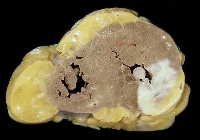 Gross autopsy photograph of a fixed human heart in cross-section, illustrating healed myocardial infarction involving the posterior and lateral left ventricular walls. The specimen demonstrates biventricular concentric hypertrophy with robust thickening of the left and right ventricles. The posterior papillary muscle shows scar tissue consistent with prior ischemic injury. The coronary arteries reveal atherosclerotic stenoses affecting the right coronary artery and the left coronary artery’s anterior interventricular branch (LAD), concordant with ischemic heart disease. Myocardial fibrosis replaces necrotic myocardium in infarcted regions, producing firm, pale areas against darker viable myocardium. The overall morphology supports a history of long-standing hypertensive cardiomyopathy with accompanying valvular insufficiency of the tricuspid and mitral valves, contributing to chronic hemodynamic burden. The image highlights key pathology: postinfarction scarring, papillary muscle involvement, and hypertrophic remodeling, which together predispose to functional mitral/tricuspid regurgitation and heart failure. This specimen is valuable for teaching gross anatomy, correlating macroscopic changes with coronary distribution and prior infarct patterns. Clinically, findings correlate with past hypertension, ischemic heart disease, and valvular disease; with autopsy context aiding diagnosis confirmation, research of myocardial remodeling, and education in cardiovascular pathology.