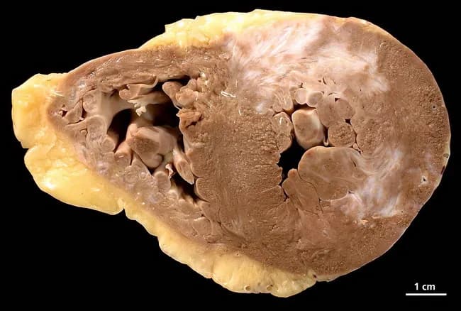 Gross pathology image of a human heart cross-section (short-axis/transverse) from a 73-year-old female with a history of arterial hypertension, chronic smoking, and three-vessel coronary artery disease. The specimen reveals chronic myocardial infarction scar throughout the myocardium with areas of subacute necrosis on both ventricles. The ventricles show concentric hypertrophy characterized by thickened ventricular walls and reduced cavity size, consistent with long-standing pressure overload. On cut surface, extensive fibrous replacement tissue is seen in the LV and RV walls, with pale, firm areas indicating scar tissue; endocardial surfaces may show thinning in infarcted zones. The presence of bilateral ventricular involvement suggests diffuse ischemic injury, possibly past infarcts with replacement fibrosis. The gross morphology corresponds to ischemic cardiomyopathy spectrum; pathophysiology includes atherosclerotic CAD, hypertension-induced hypertrophy, and chronic subendocardial ischemia. This combination results in remodeling and scar formation, predisposing to arrhythmias and heart failure. The image is from pathorama.ch, illustrating classic post-infarction changes: myocardial scar, subacute necrosis, and hypertrophic remodeling. Clinically, such pathology would correlate with prior chest pain episodes, elevated troponin in the past, and radiographic evidence of cardiomegaly; autopsy or pathology reporting would emphasize chronic infarct burden, LV dysfunction, and risk stratification for sudden cardiac death. Suitable for education on myocardial infarction progression and necrosis patterns.