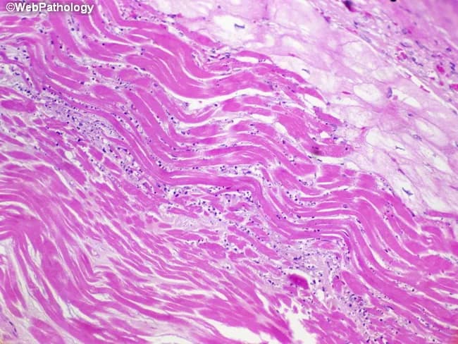 Imaging modality: light microscopy of a cardiac tissue section stained with hematoxylin and eosin reveals infarct border-zone myocardium from the left ventricle. The tissue shows parallel, wavy myocardial fibers along the border between viable and necrotic tissue—a hallmark of early coagulative necrosis in myocardial infarction. The fibers appear elongated and noncontractile, with eosinophilic (pink) cytoplasm and loss of distinctive cross-striations; nuclei are scarce or absent in necrotic cells. In the periphery, viable myocytes tug on adjacent fibers during systole, producing the characteristic waviness. The infarct core is hypo-cellular with meshy eosinophilic areas and early inflammatory cells beginning to infiltrate, consistent with the 6–12 hour window after ischemic onset. These histologic changes reflect irreversible injury, rapid necrosis, and initiation of repair processes. Clinically, recognition of wavy fibers and coagulative necrosis supports an acute MI diagnosis and helps estimate timing, guiding anti-ischemic therapy, reperfusion decisions, and prognostic assessment. This image is representative in education and research contexts for teaching infarct evolution, distinguishing acute from subacute tissue changes, and illustrating the border zone pathophysiology in cardiology and pathology education. This micrograph serves as a teaching tool for students, residents, and researchers studying ischemic injury timelines, scar formation, and therapeutic windows in infarcted myocardium.